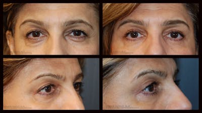 Blepharoplasty (Eyelid Surgery) Before & After Gallery - Patient 390991 - Image 1