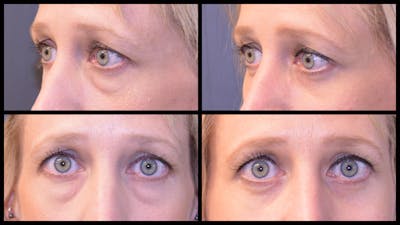 Blepharoplasty (Eyelid Surgery) Before & After Gallery - Patient 228337 - Image 1