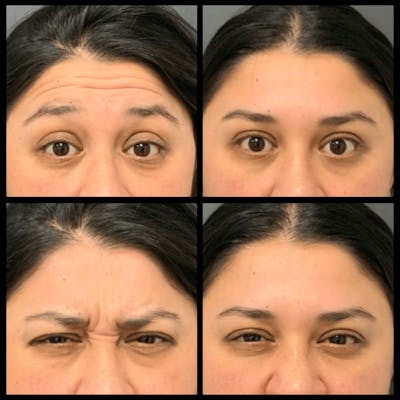 BOTOX Before & After Gallery - Patient 940396 - Image 1
