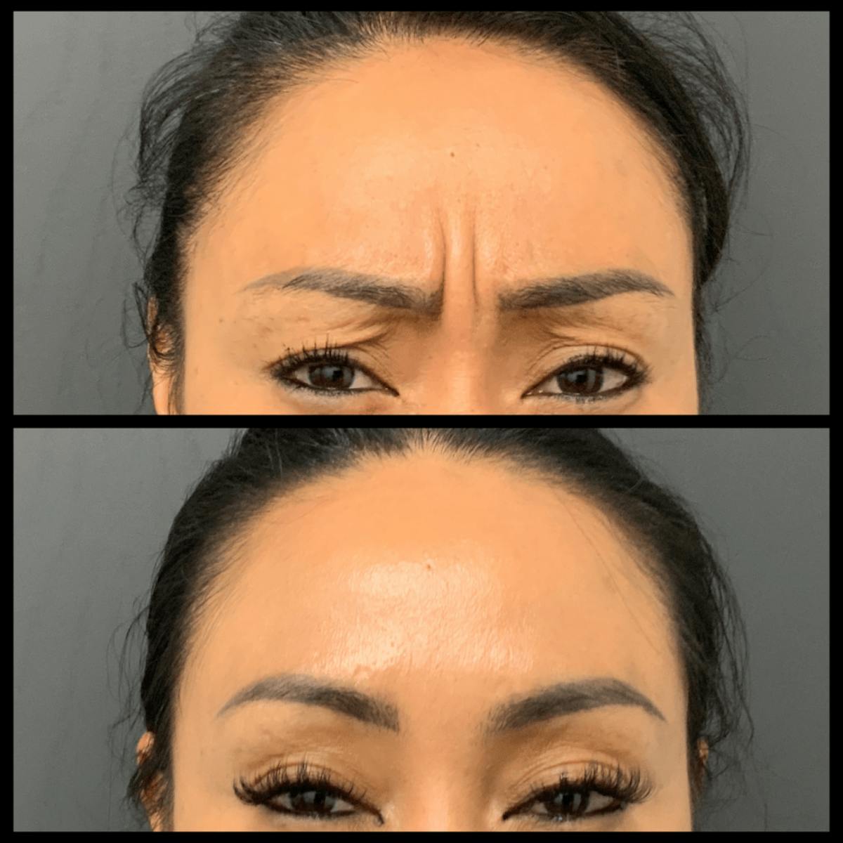 BOTOX Before & After Gallery - Patient 760715 - Image 1