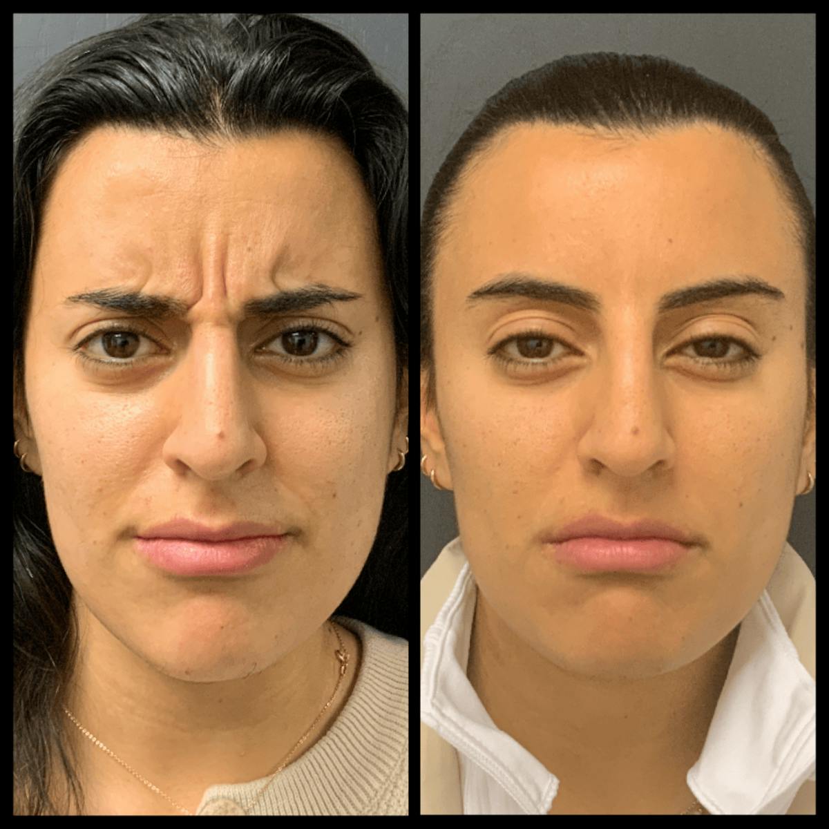 BOTOX Before & After Gallery - Patient 386320 - Image 1