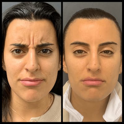 BOTOX Before & After Gallery - Patient 386320 - Image 1