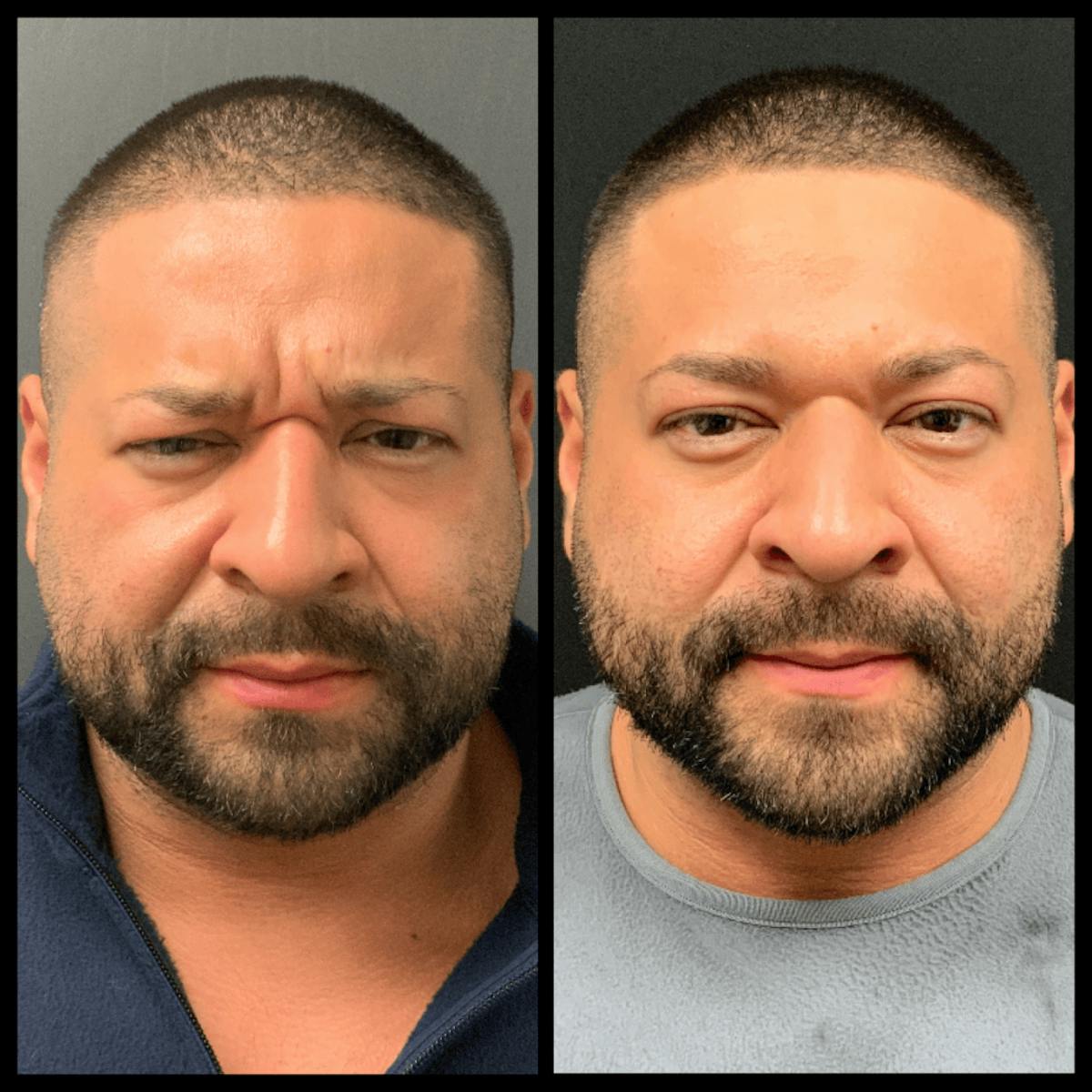 BOTOX Before & After Gallery - Patient 382698 - Image 1