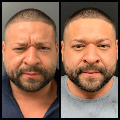 BOTOX Before & After Gallery - Patient 382698 - Image 1