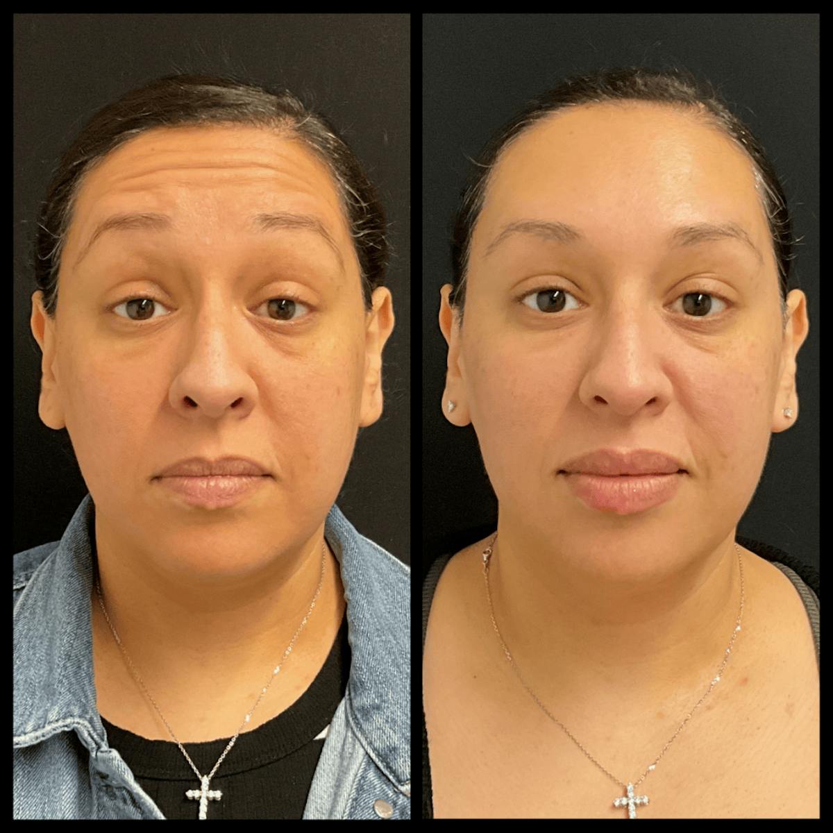 BOTOX Before & After Gallery - Patient 101462 - Image 1