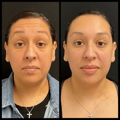 BOTOX Before & After Gallery - Patient 101462 - Image 1