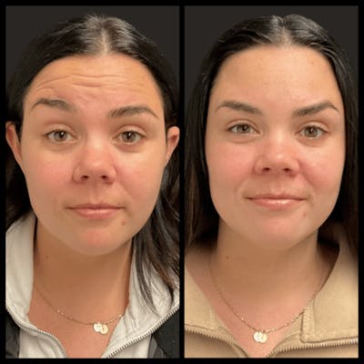 BOTOX Before & After Gallery - Patient 178375 - Image 1