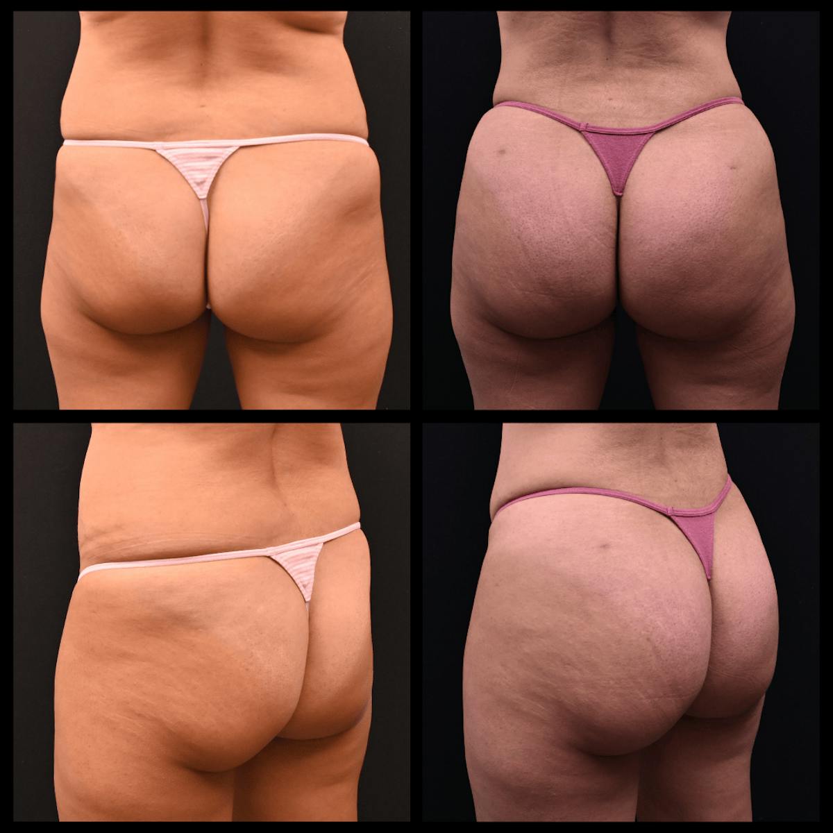 Brazilian Butt Lift Before & After Gallery - Patient 164443 - Image 1