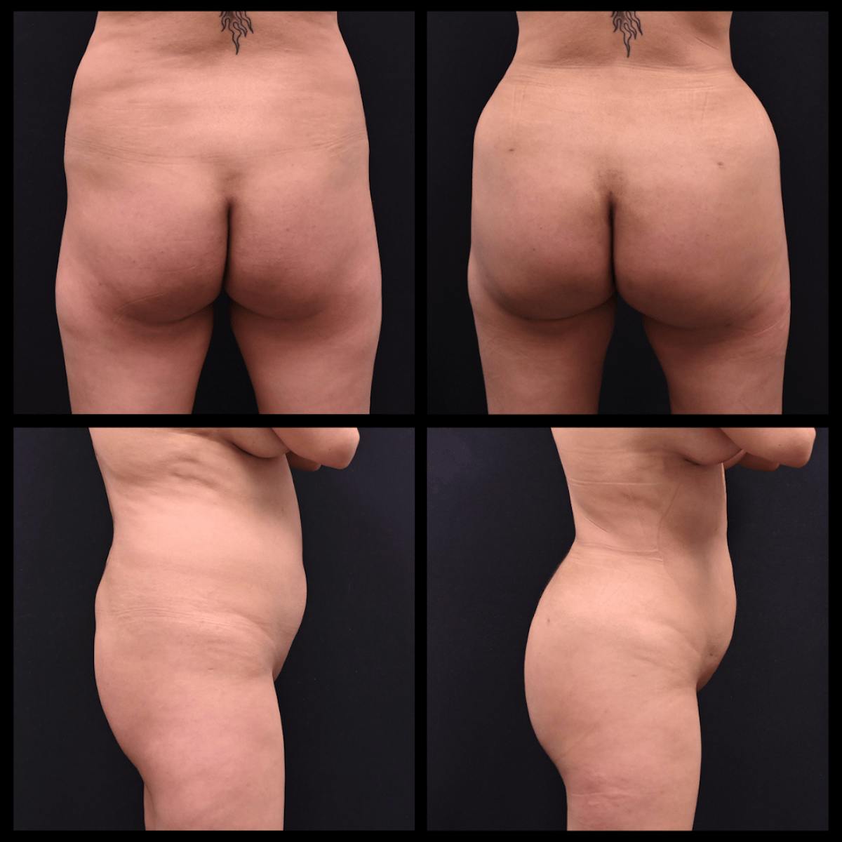 Brazilian Butt Lift Before & After Gallery - Patient 229247 - Image 1