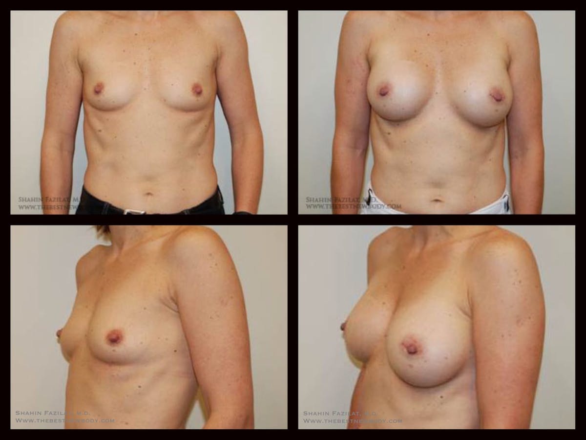 Breast Augmentation Before & After Gallery - Patient 189978 - Image 1