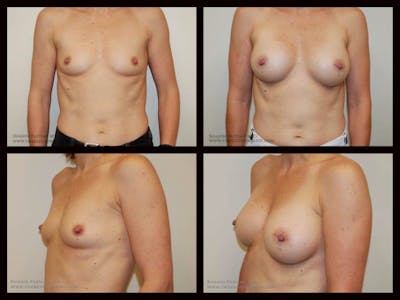 Breast Augmentation Before & After Gallery - Patient 189978 - Image 1