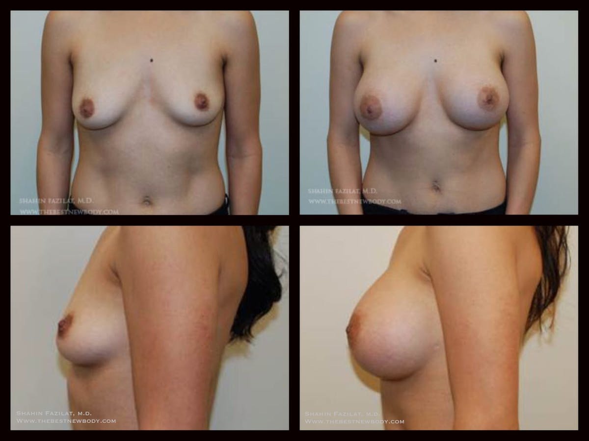 Breast Augmentation Before & After Gallery - Patient 312779 - Image 1