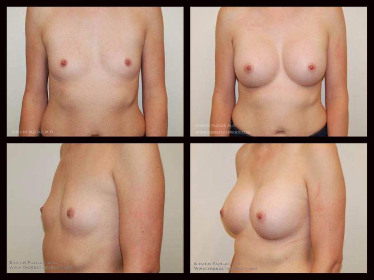 Breast Augmentation Before & After Gallery - Patient 401926 - Image 1