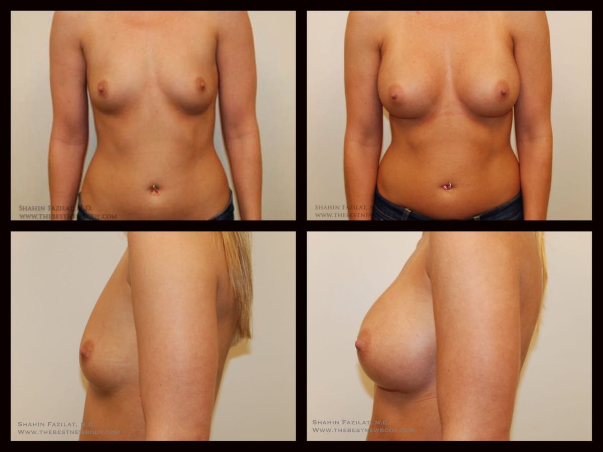 Breast Augmentation Before & After Gallery - Patient 176711 - Image 1