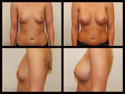 Breast Augmentation Before & After Gallery - Patient 176711 - Image 1