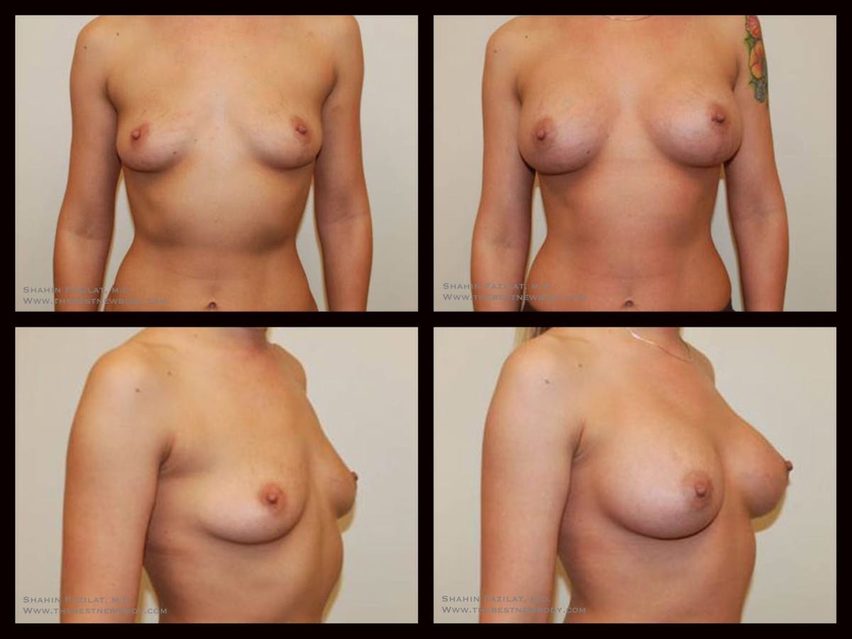 Breast Augmentation Before & After Gallery - Patient 142970 - Image 1