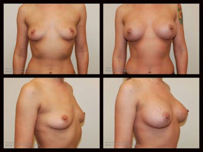 Breast Augmentation Before & After Gallery - Patient 142970 - Image 1