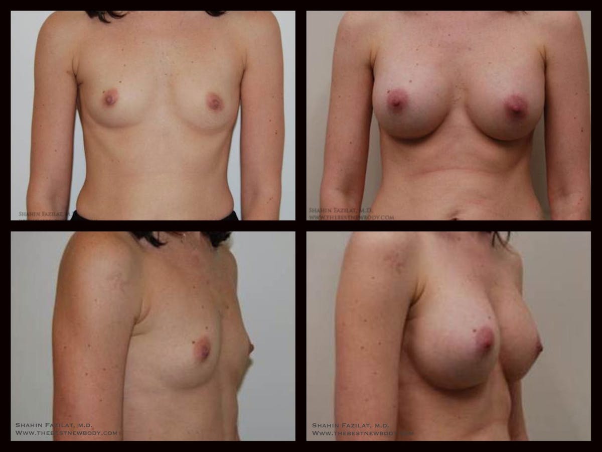 Breast Augmentation Before & After Gallery - Patient 724514 - Image 1