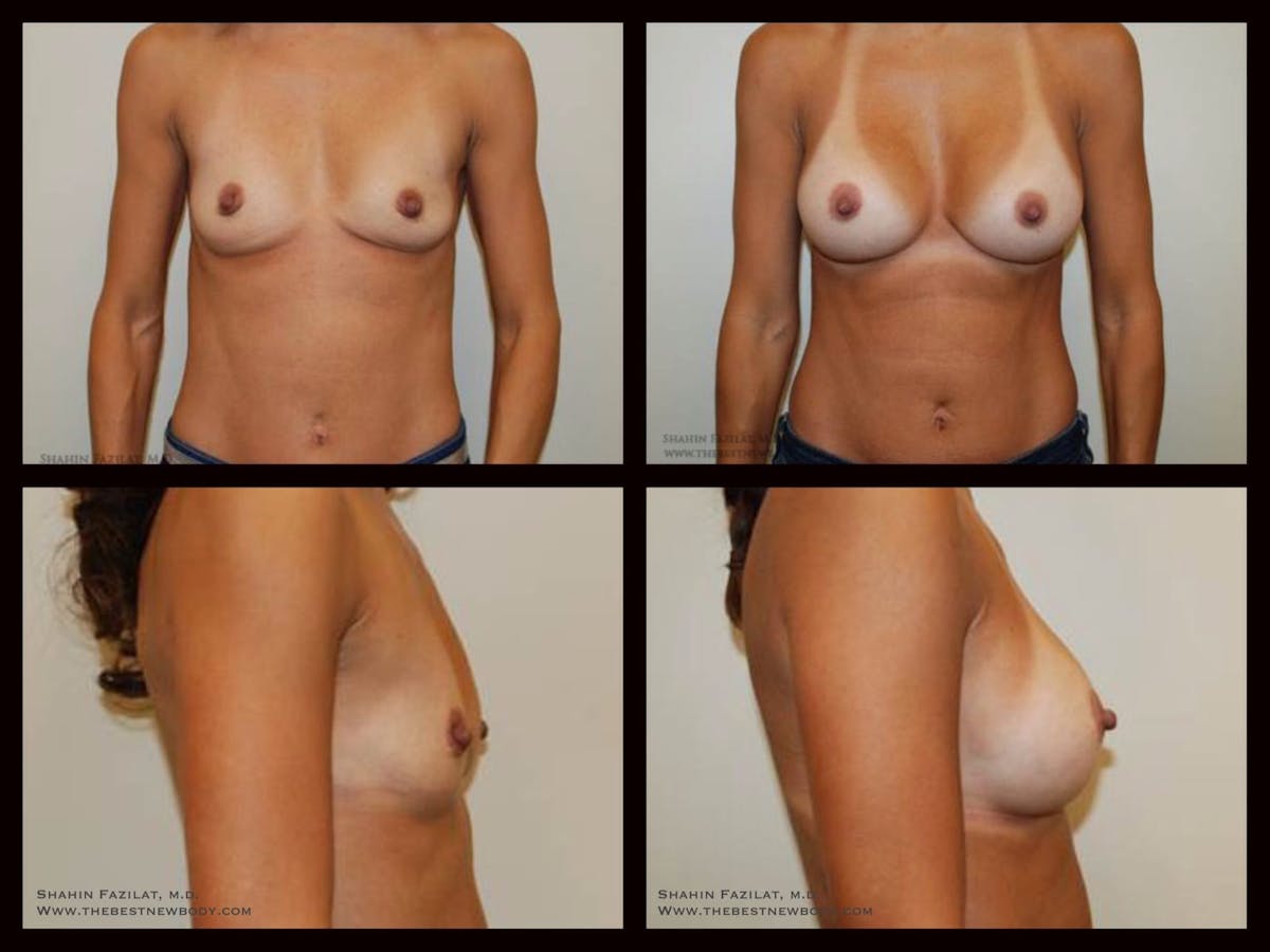 Breast Augmentation Before & After Gallery - Patient 296298 - Image 1