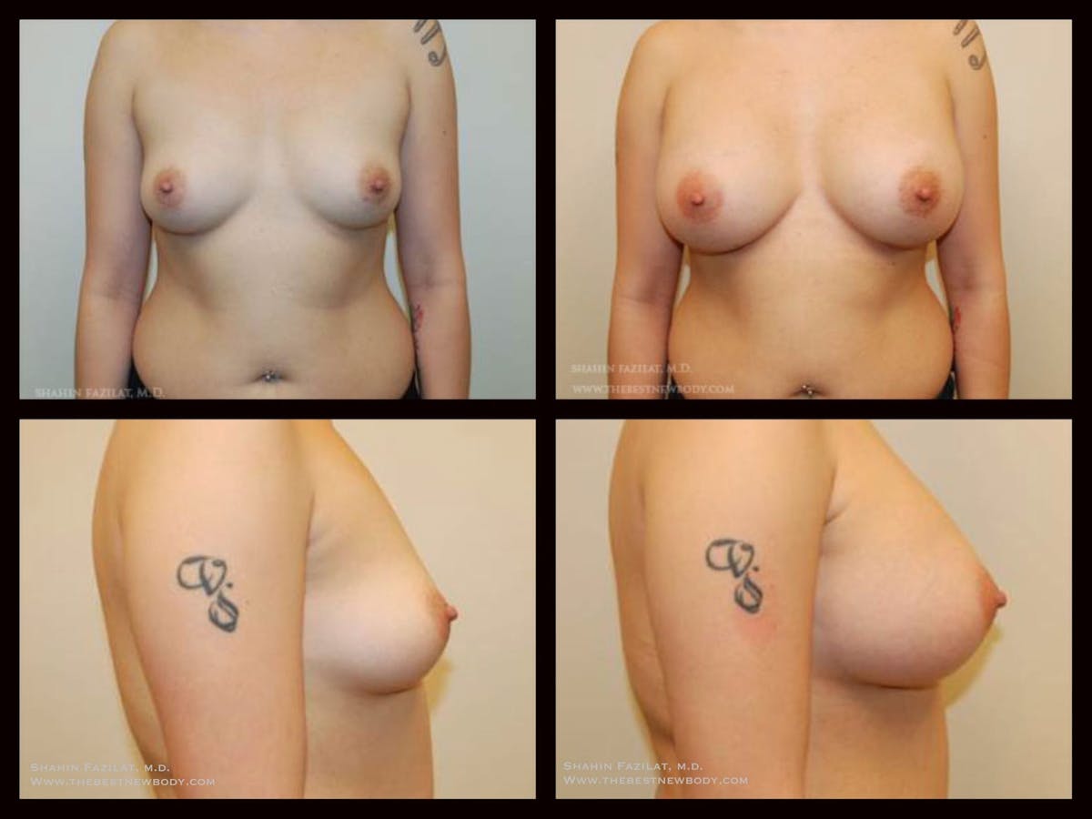 Breast Augmentation Before & After Gallery - Patient 144084 - Image 1