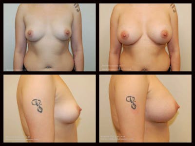 Breast Augmentation Before & After Gallery - Patient 144084 - Image 1