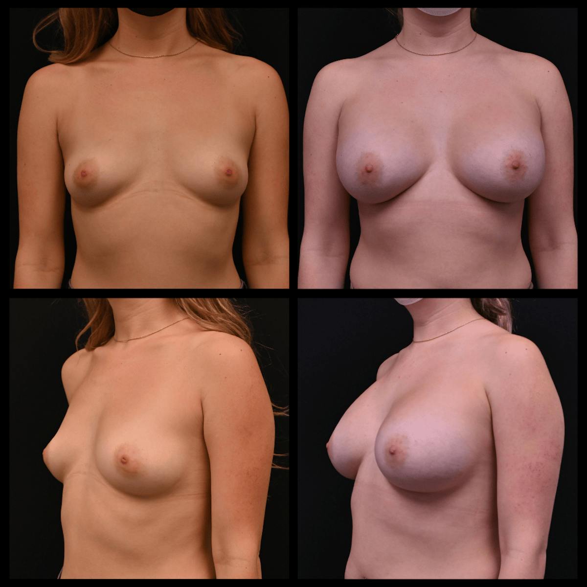 Breast Augmentation Before & After Gallery - Patient 133837 - Image 1