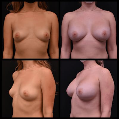 Breast Augmentation Before & After Gallery - Patient 133837 - Image 1