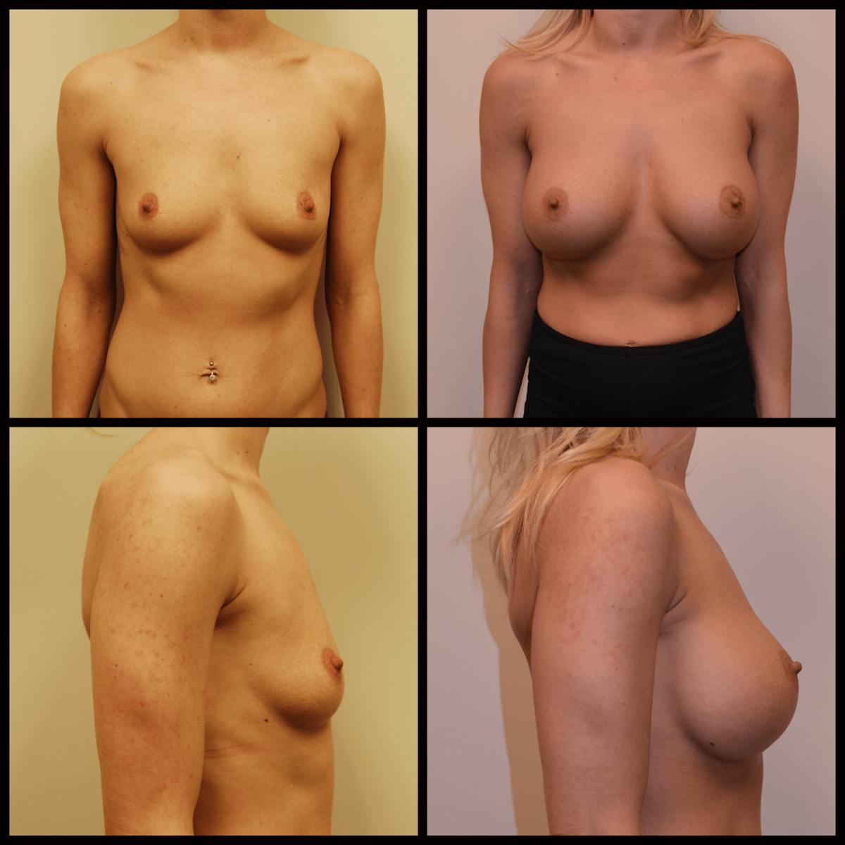 Breast Augmentation Before & After Gallery - Patient 722069 - Image 1