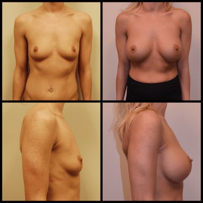 Breast Augmentation Before & After Gallery - Patient 722069 - Image 1