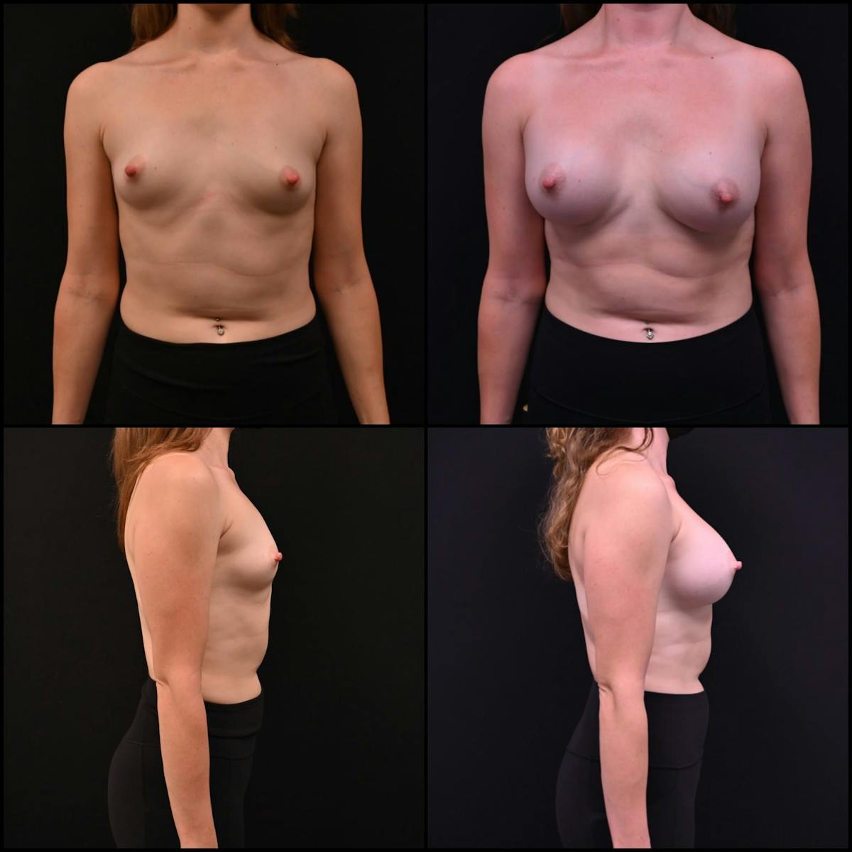 Breast Augmentation Before & After Gallery - Patient 311510 - Image 1