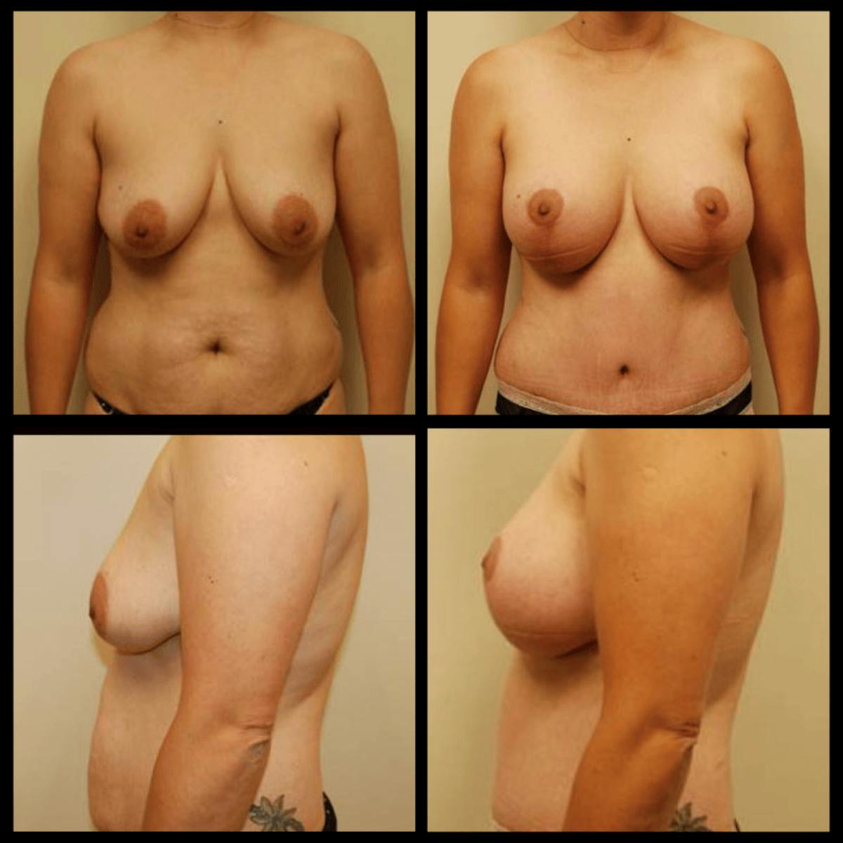 Breast Augmentation with Lift Before & After Gallery - Patient 373777 - Image 1