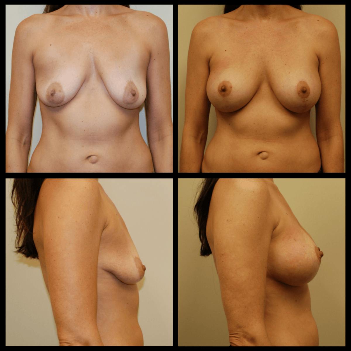 Breast Augmentation with Lift Before & After Gallery - Patient 184514 - Image 1