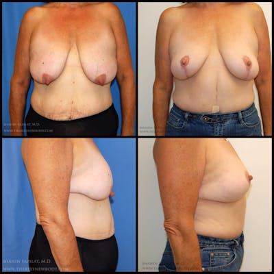 Breast Lift Before & After Gallery - Patient 800822 - Image 1