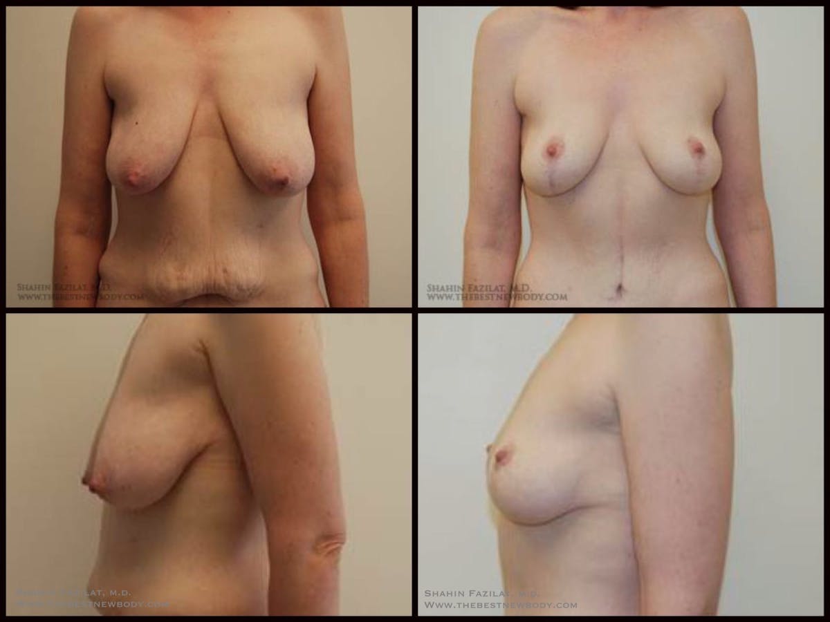 Breast Lift Before & After Gallery - Patient 255046 - Image 1