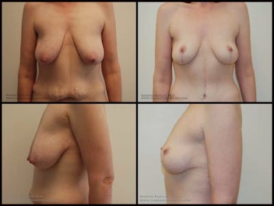 Breast Lift Before & After Gallery - Patient 255046 - Image 1