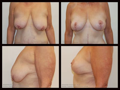 Breast Lift Before & After Gallery - Patient 390630 - Image 1