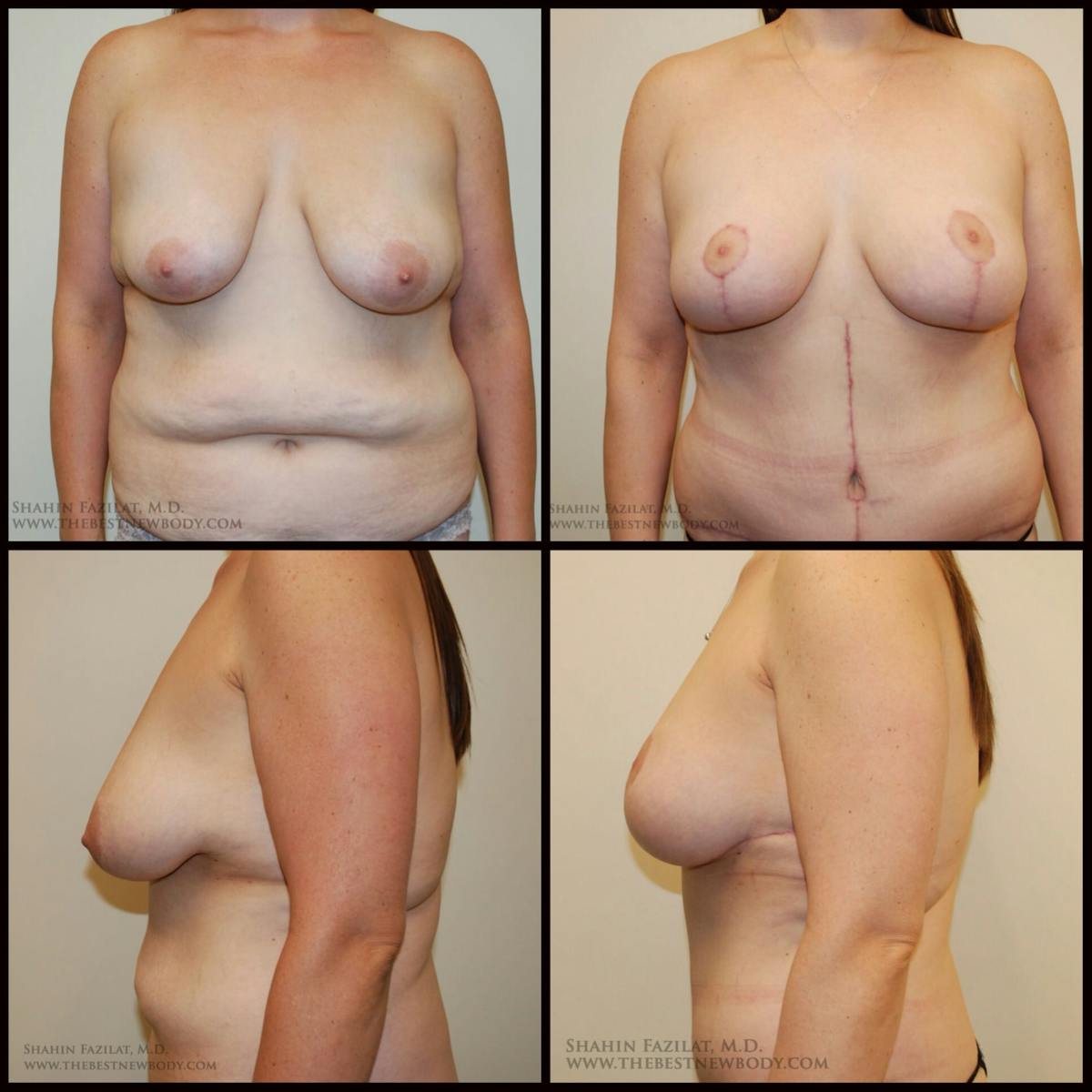 Breast Lift Before & After Gallery - Patient 318472 - Image 1