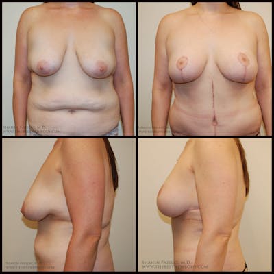 Breast Lift Before & After Gallery - Patient 318472 - Image 1