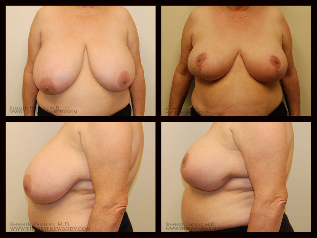 Breast Reduction Before & After Gallery - Patient 418746 - Image 1