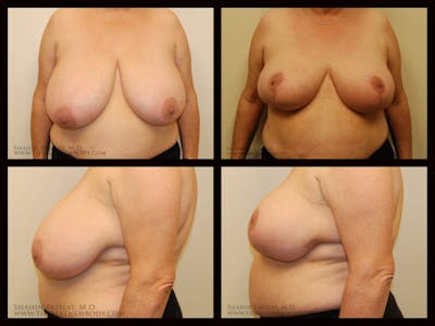 Breast Reduction Before & After Gallery - Patient 418746 - Image 1