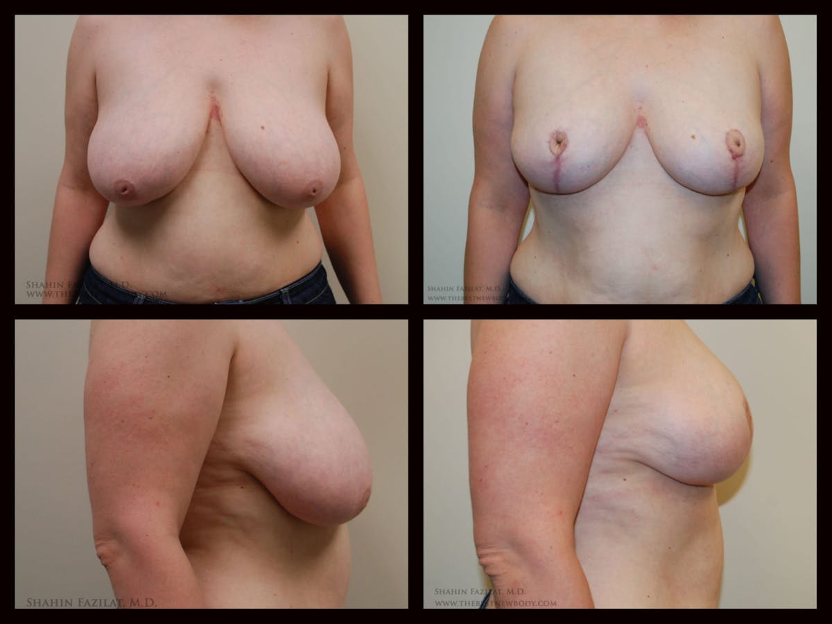 Breast Reduction Before & After Gallery - Patient 270515 - Image 1