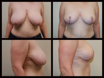 Breast Reduction Before & After Gallery - Patient 270515 - Image 1