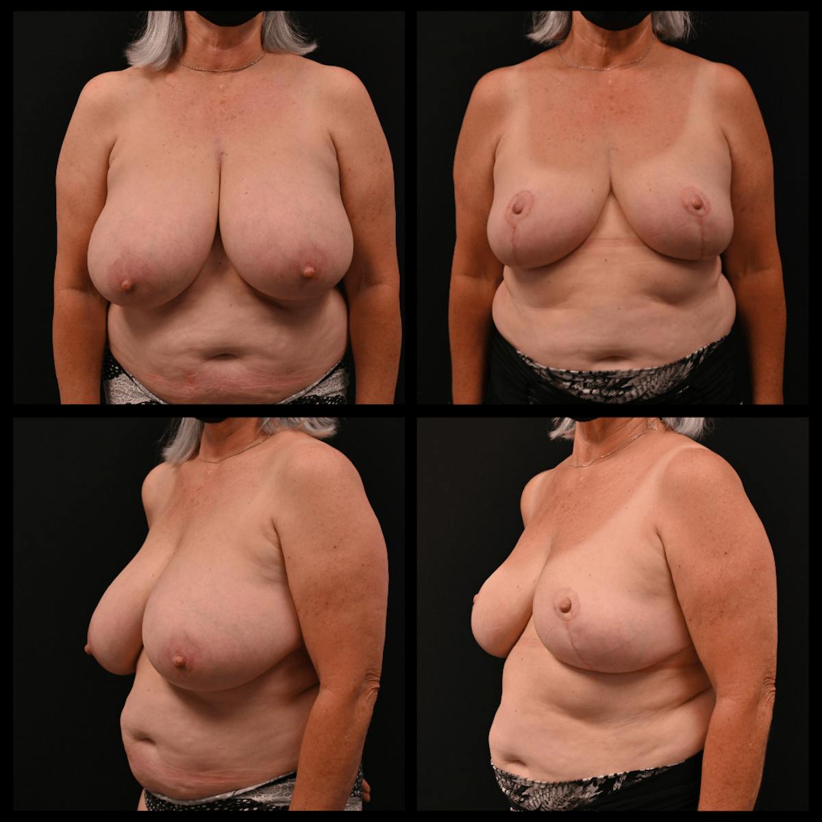 Breast Reduction Before & After Gallery - Patient 110282 - Image 1