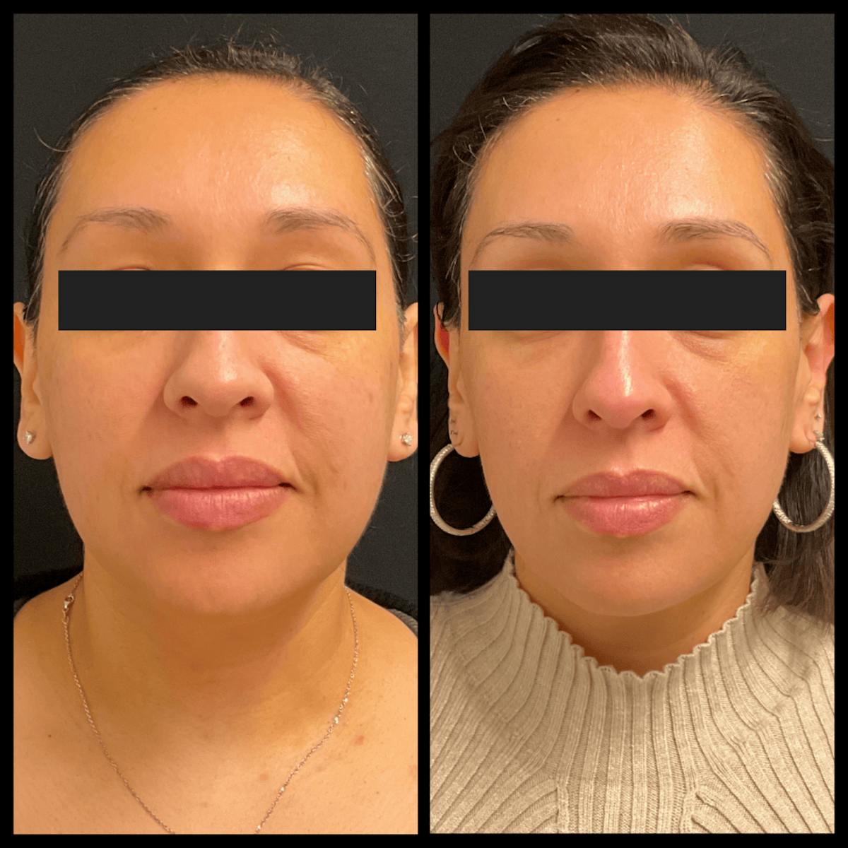 Clear + Brilliant Treatments Before & After Gallery - Patient 232004 - Image 1