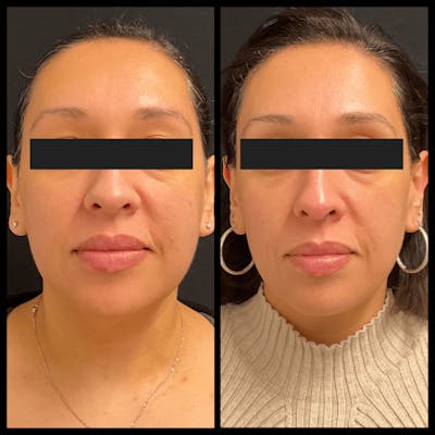 Clear + Brilliant Treatments Before & After Gallery - Patient 232004 - Image 1