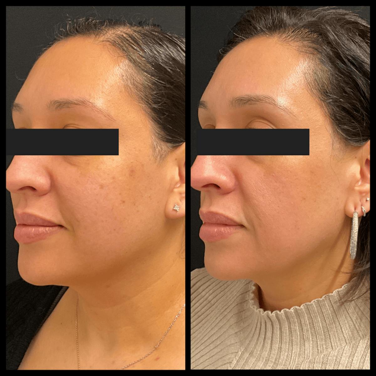 Clear + Brilliant Treatments Before & After Gallery - Patient 232004 - Image 2