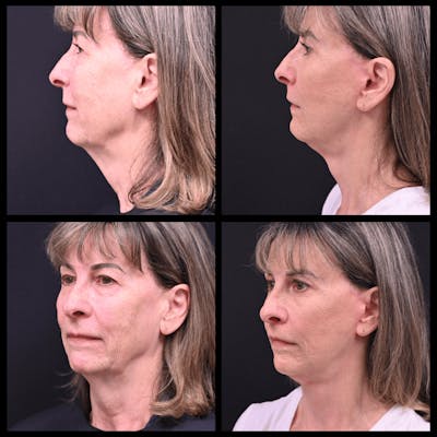 Face/Neck Lift Before & After Gallery - Patient 291566 - Image 1