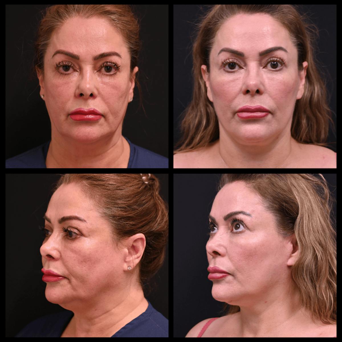 Face/Neck Lift Before & After Gallery - Patient 339565 - Image 1