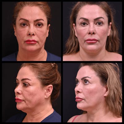 Face/Neck Lift Before & After Gallery - Patient 339565 - Image 1