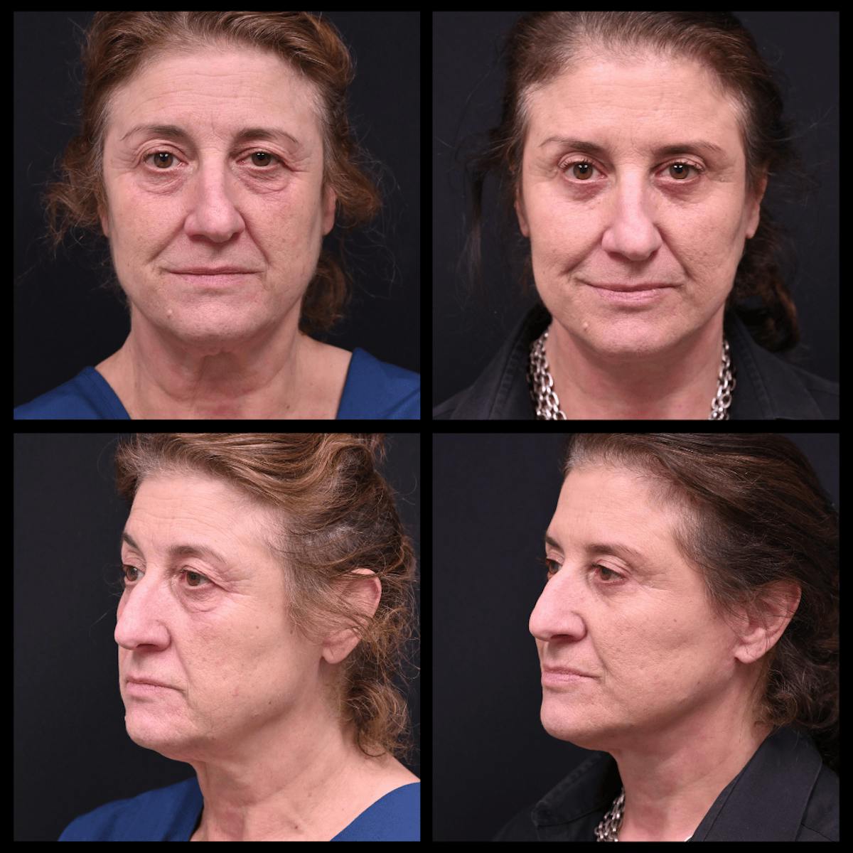 Face/Neck Lift Before & After Gallery - Patient 348866 - Image 1